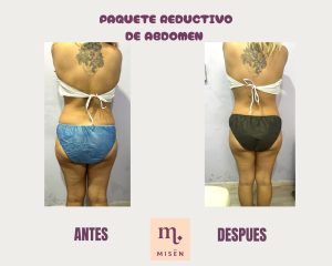 Home reductivo